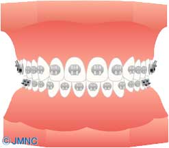 ブラケット矯正