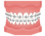歯の矯正装置
