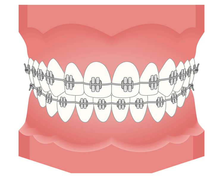 歯の矯正装置