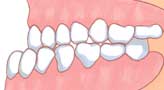 イラスト図：受け口の歯列