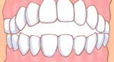 イラスト図：前歯が閉じない歯
