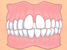 イラスト図：空隙歯列（くうげきしれつ）